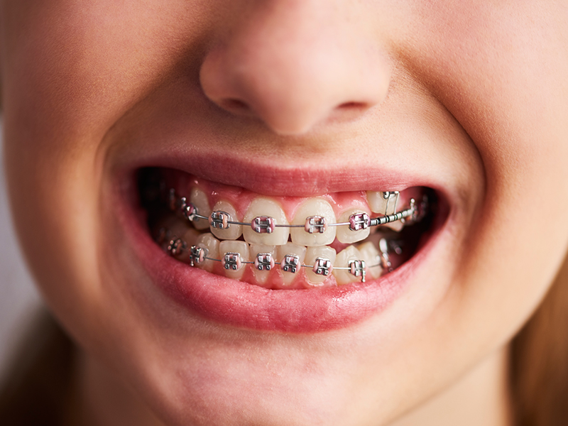 aparat dentar copii stomatologie reșița