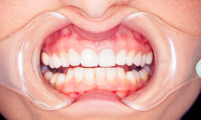 remodelare gingivală stomatologie resita